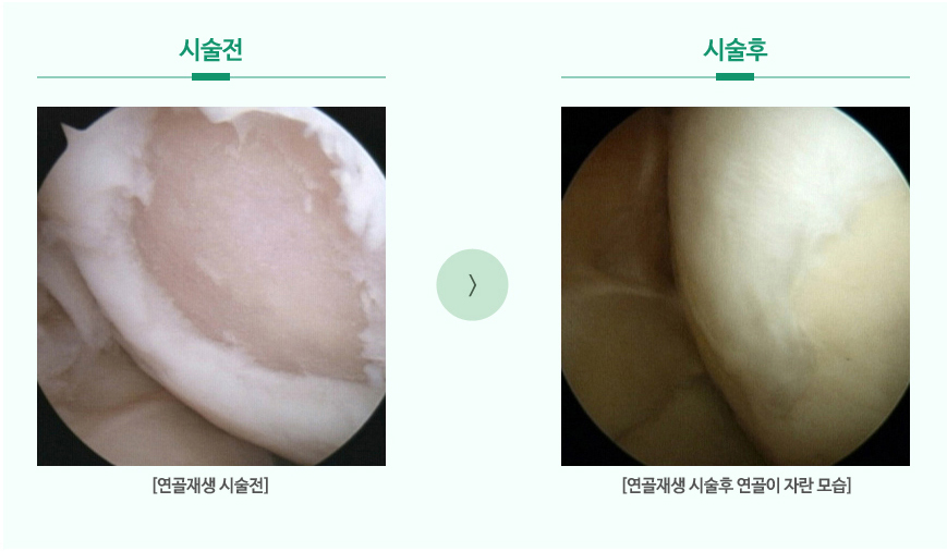 무릎연골재생술